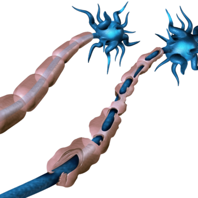 Multiple Sclerosis nerve - healthy v damaged myelin